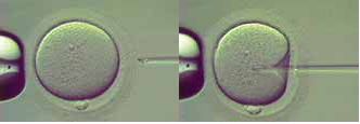 IVF IVF