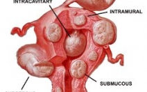 Děložní myomy a poruchy plodnosti - obrázek