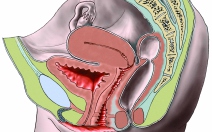 Endometrióza - obrázek