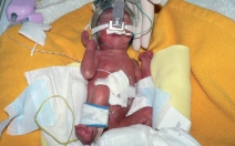 RSV infekce u předčasně narozených dětí - obrázek