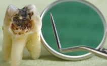 Vliv stravy na vznik a rozvoj  zubního kazu - 1.díl - obrázek